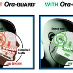 New Nighttime Grind Guard Relieves Jaw Pain