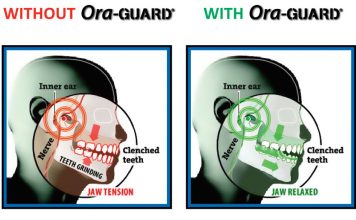 New Nighttime Grind Guard Relieves Jaw Pain